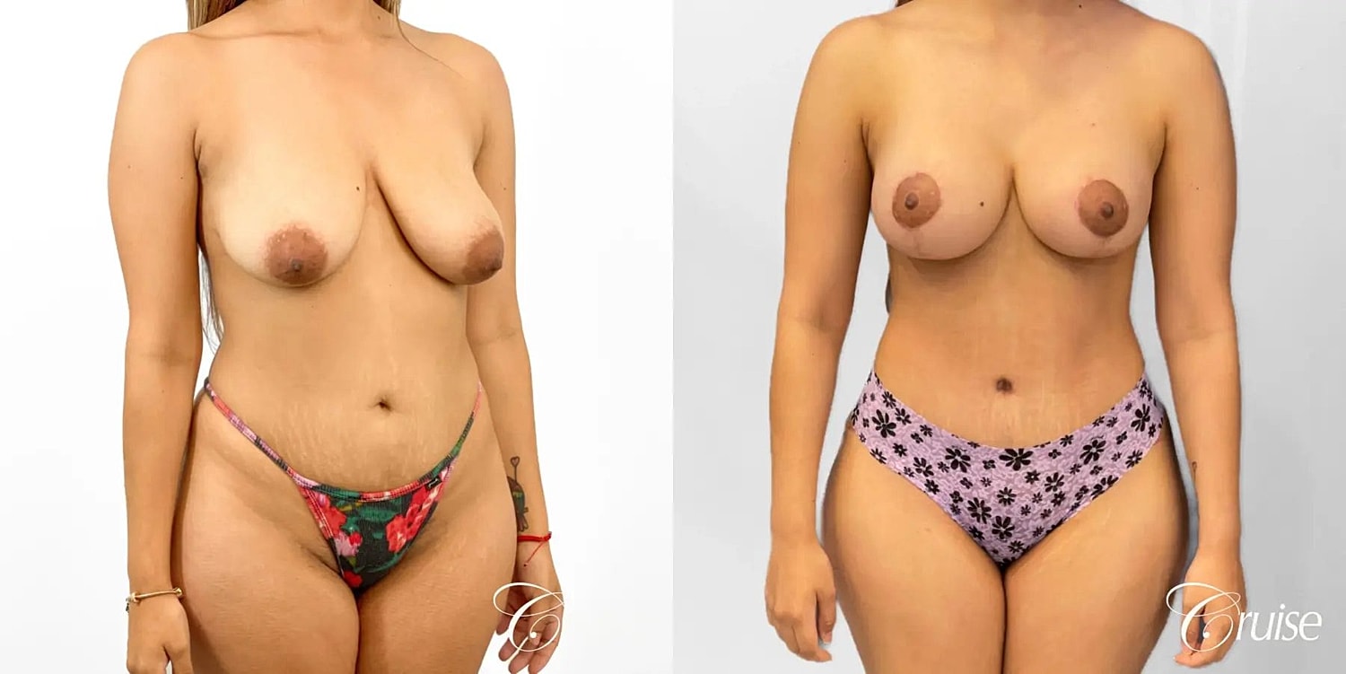 Mommy Makeover Before & After