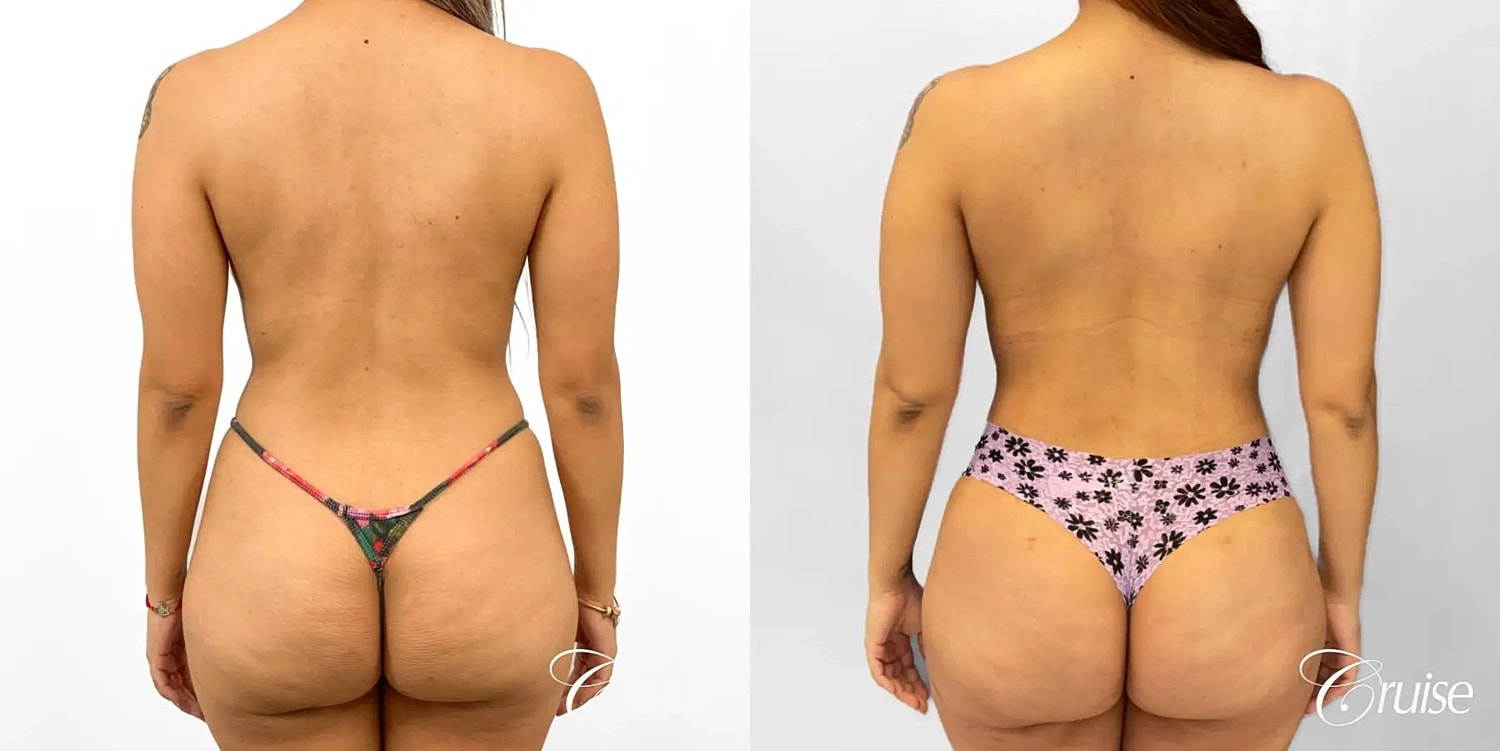 Mommy Makeover Before & After