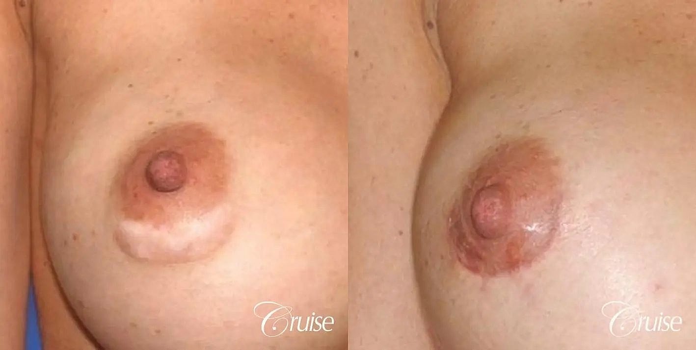 Scar Revision Before & After