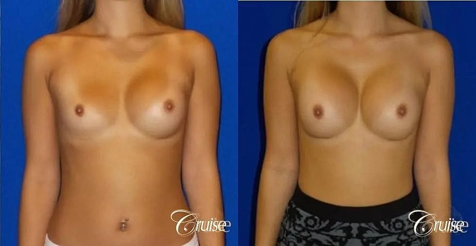 Breast Revision Before & After