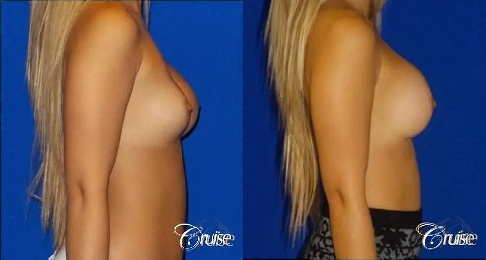 Breast Revision Before & After