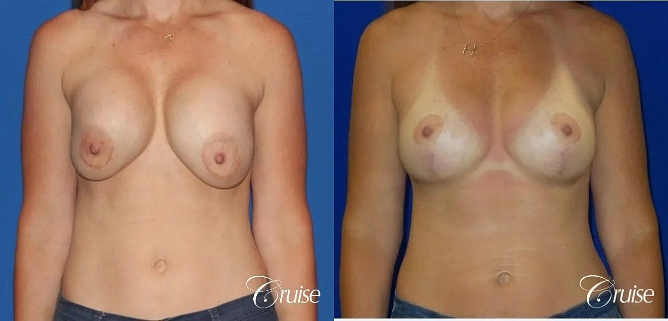 Breast Revision Before & After