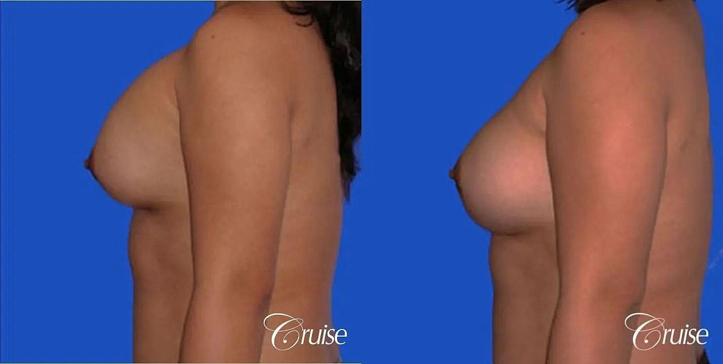 Breast Revision Before & After