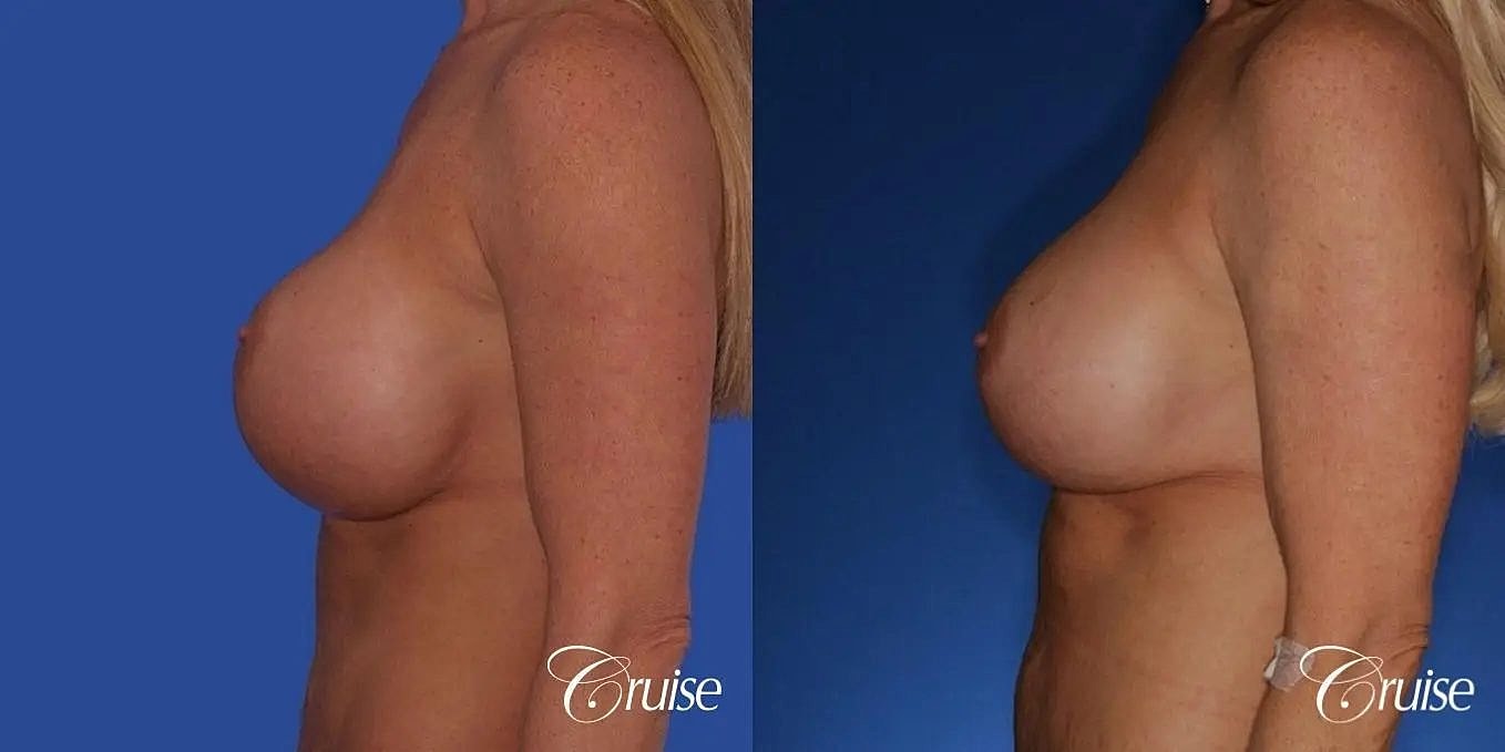 Breast Revision Before & After