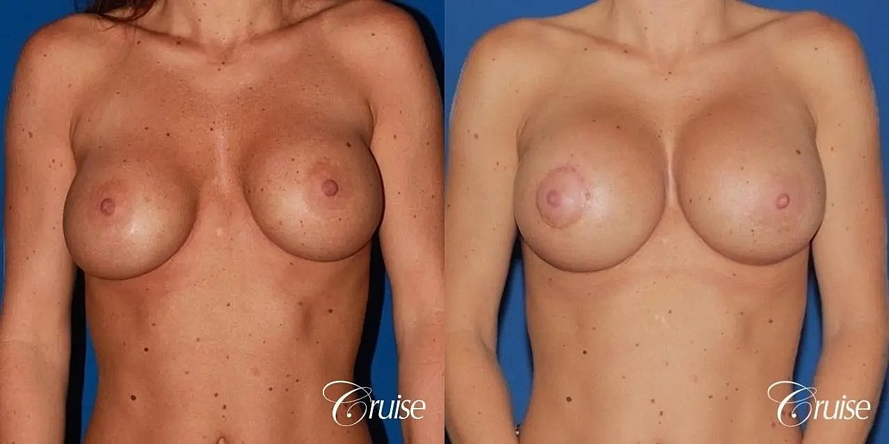 Breast Revision Before & After