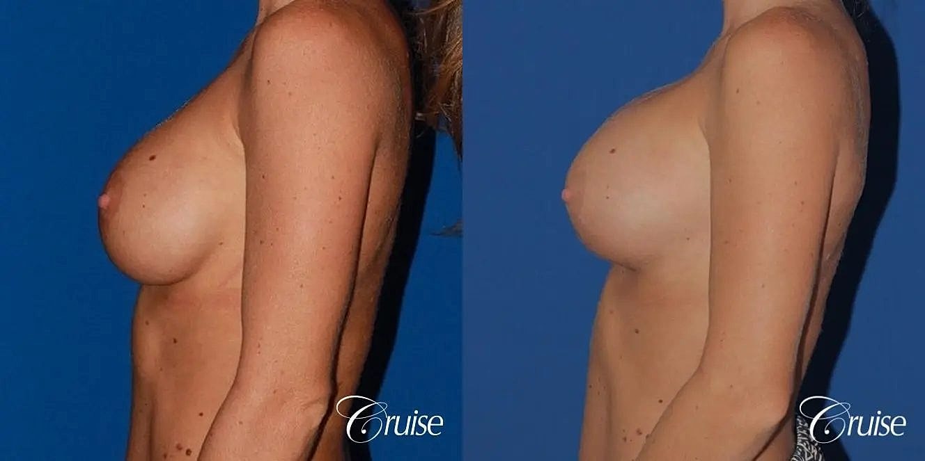 Breast Revision Before & After