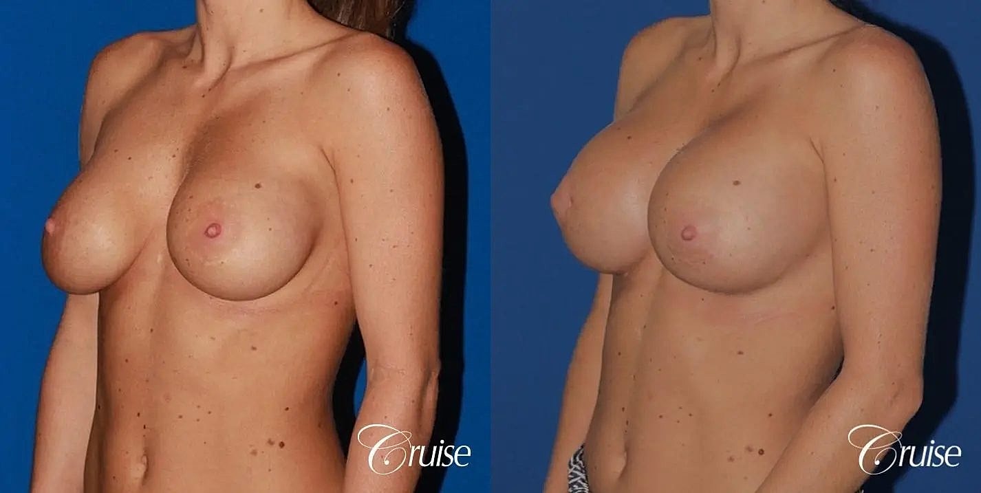 Breast Revision Before & After