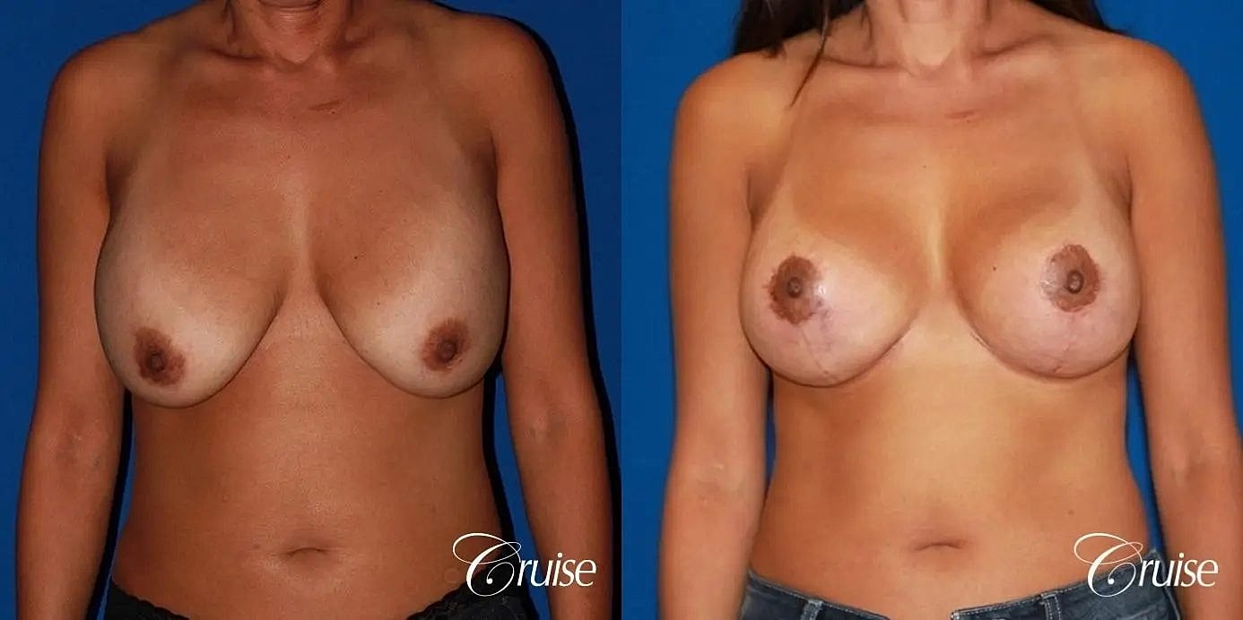 Breast Revision Before & After