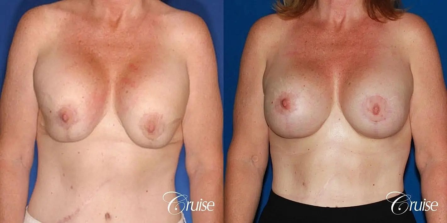 Breast Revision Before & After