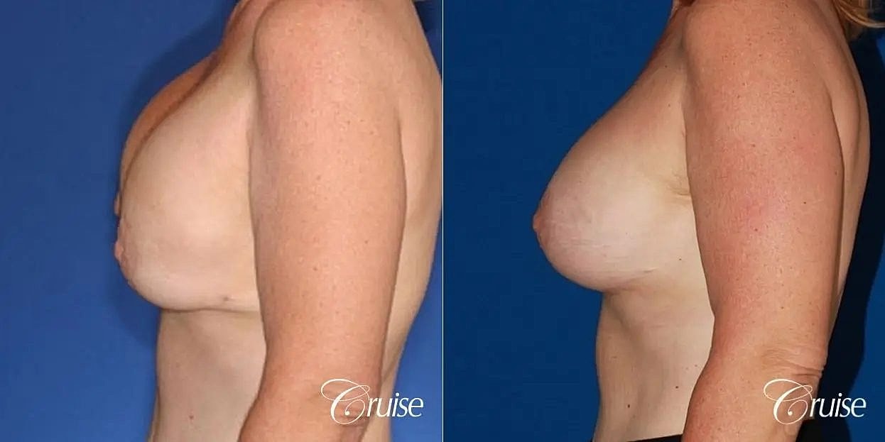 Breast Revision Before & After
