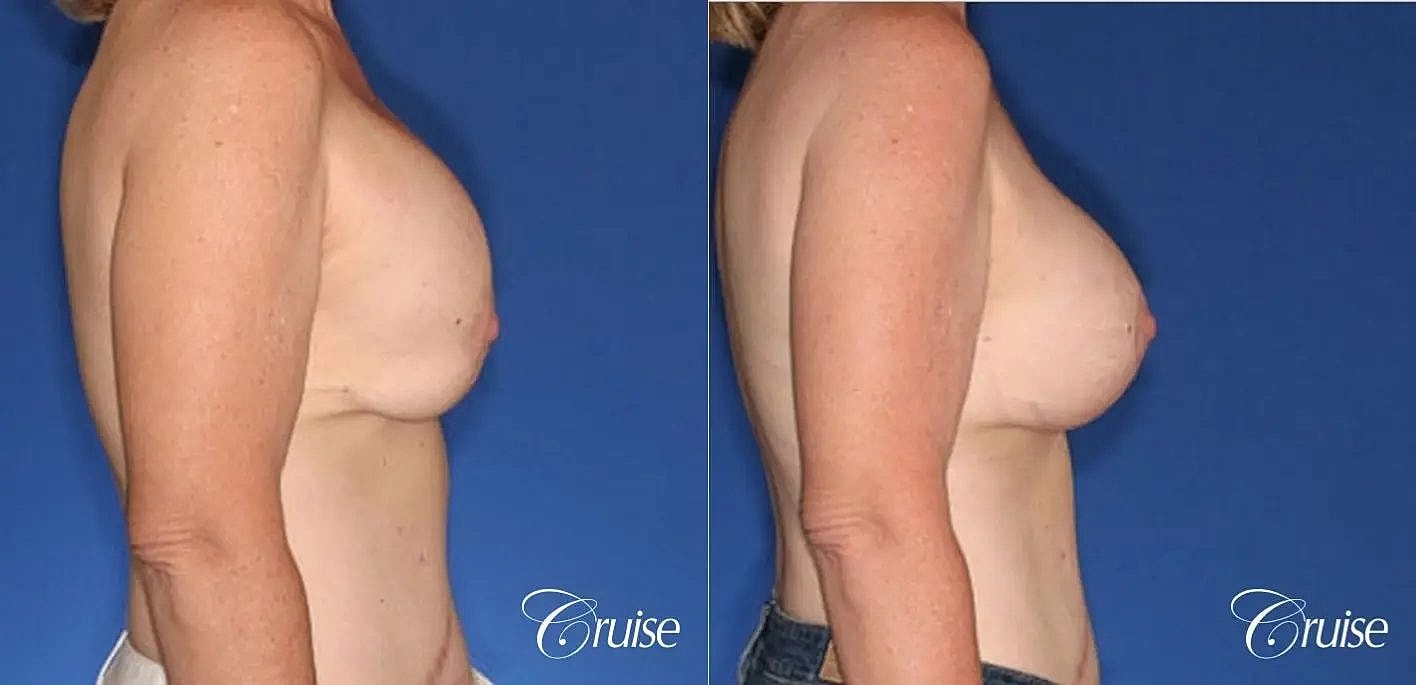 Breast Revision Before & After