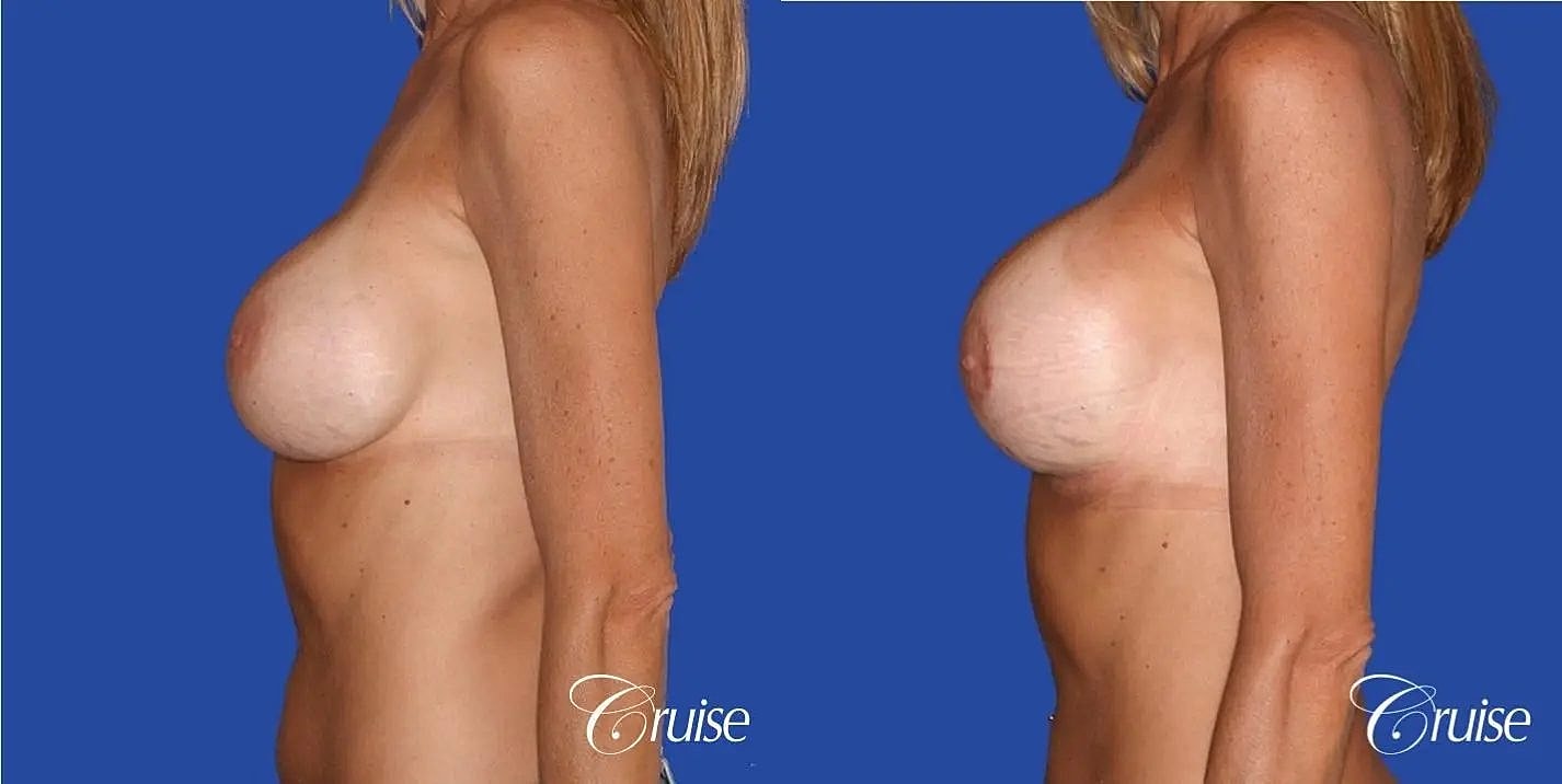 Breast Revision Before & After