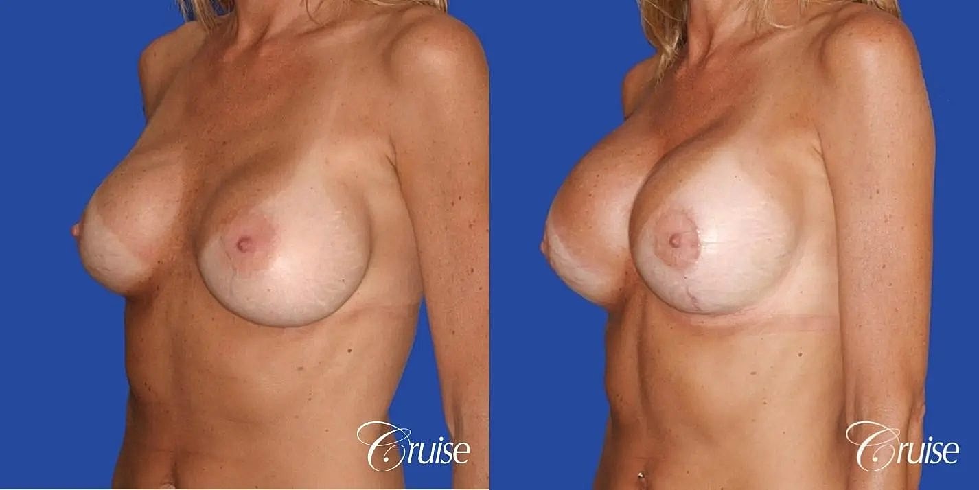 Breast Revision Before & After