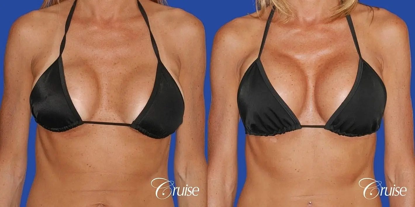 Breast Revision Before & After
