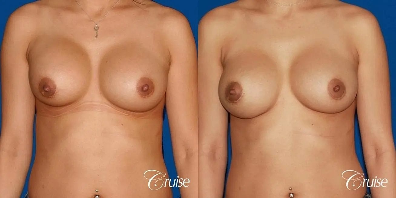 Breast Revision Before & After