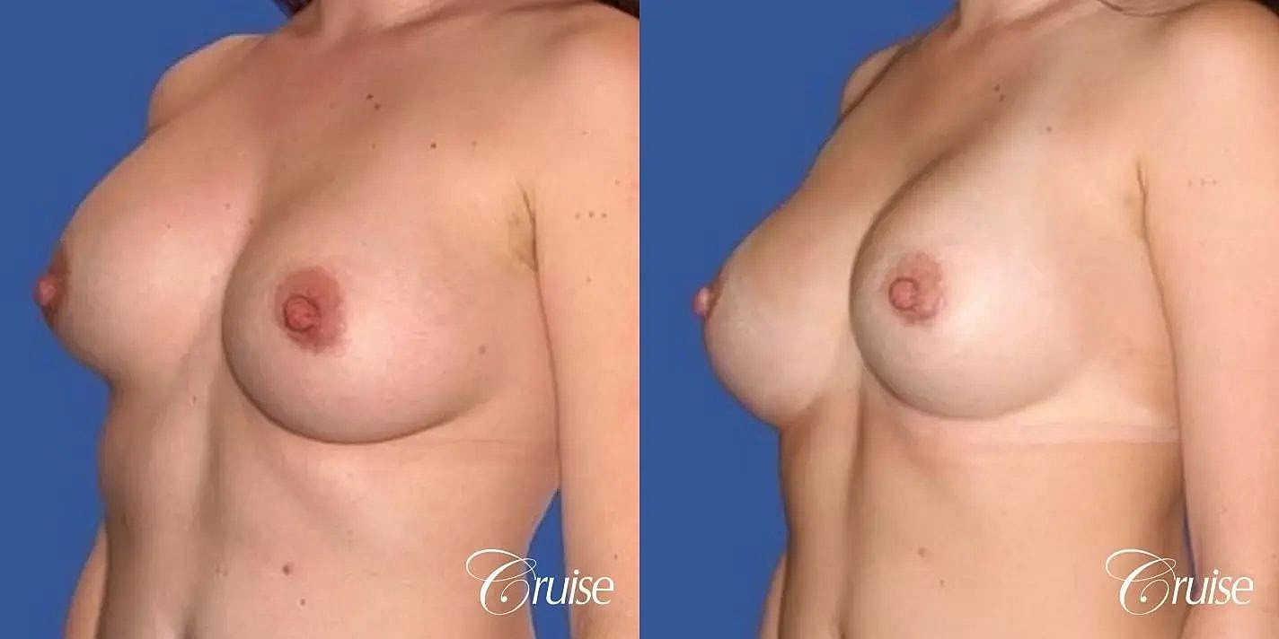 Breast Revision Before & After