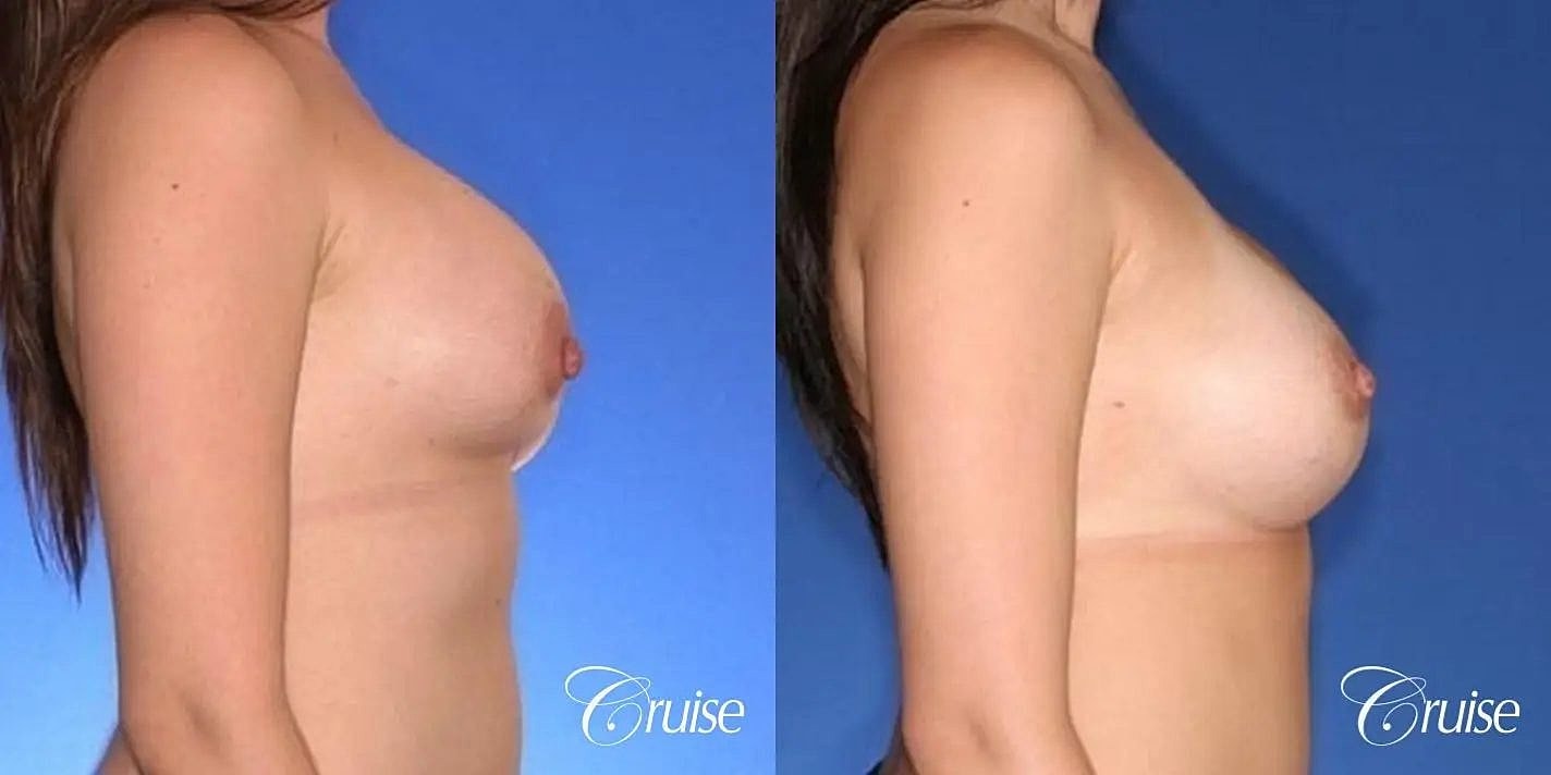 Breast Revision Before & After