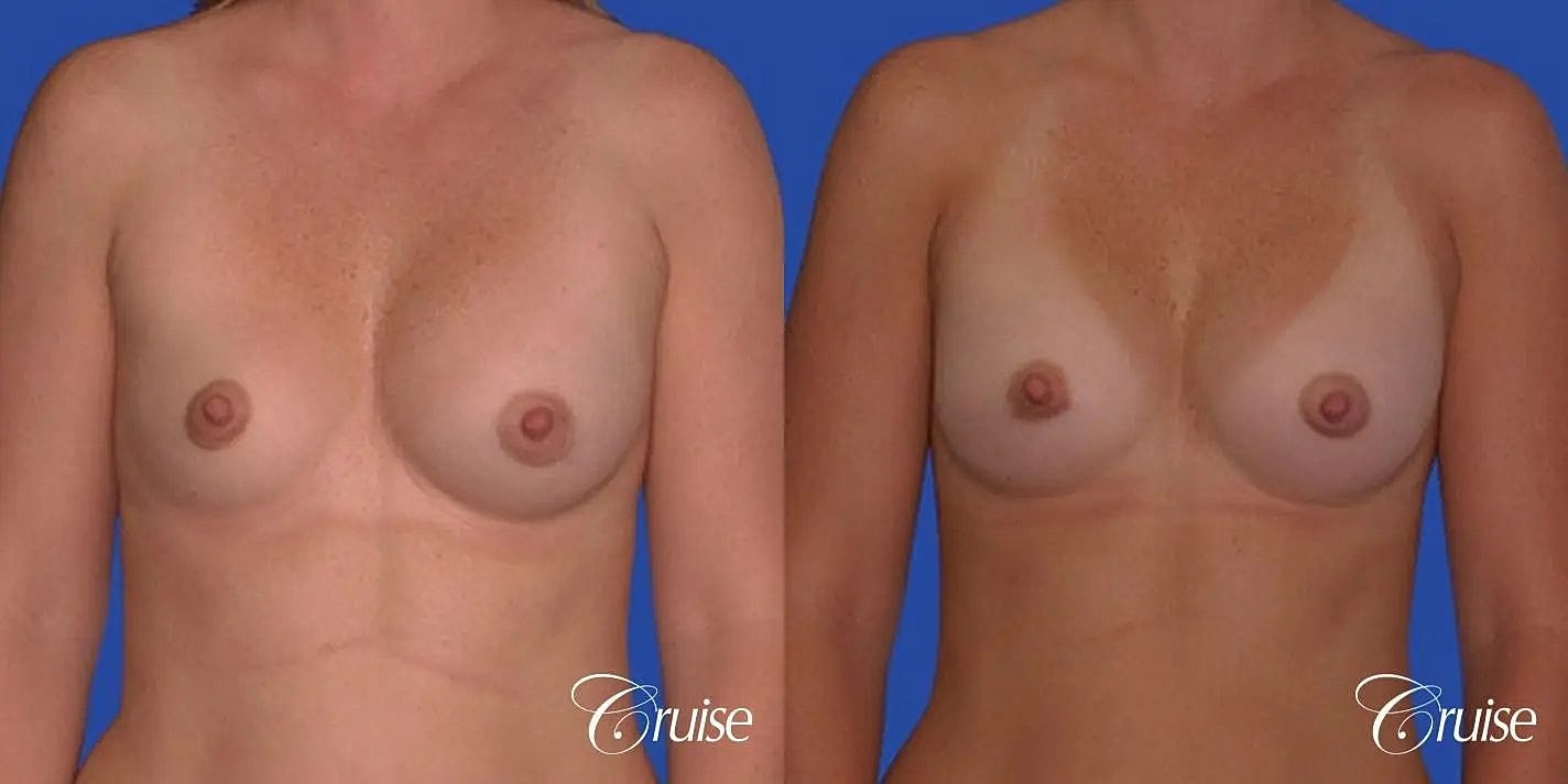Breast Revision Before & After