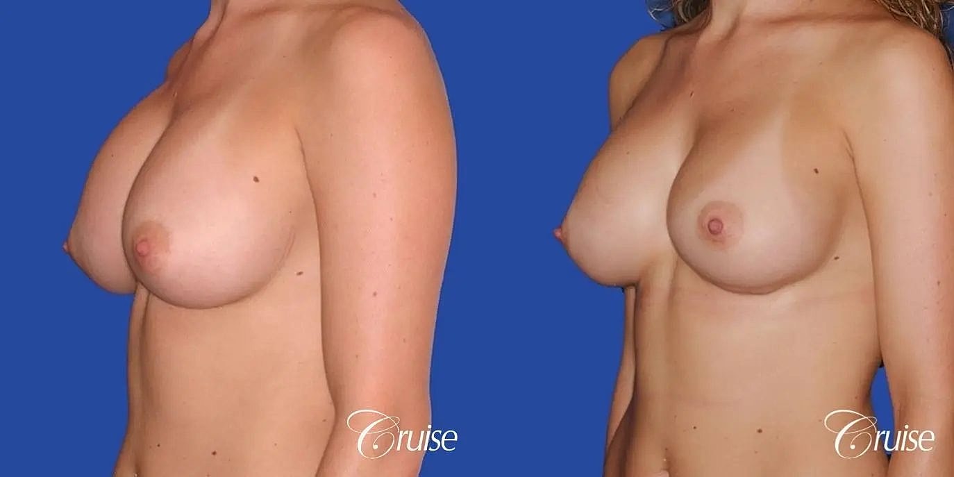 Breast Revision Before & After
