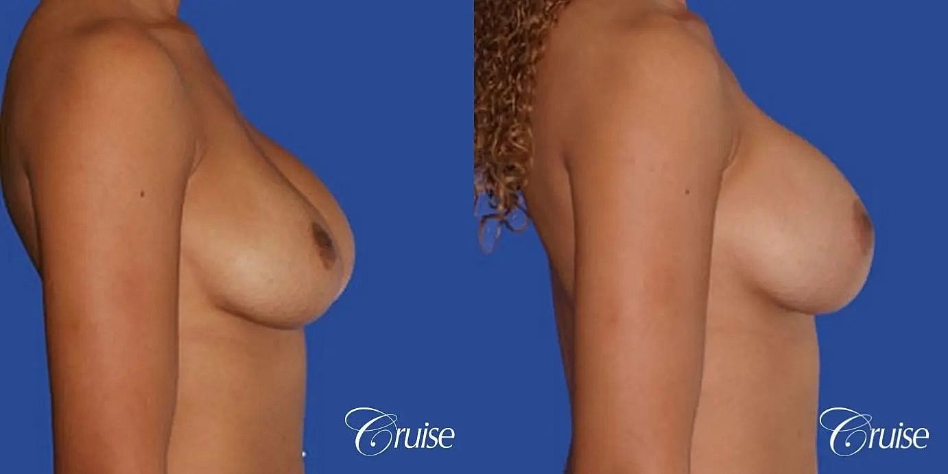 Breast Revision Before & After