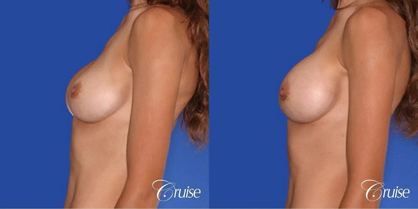 Breast Revision Before & After