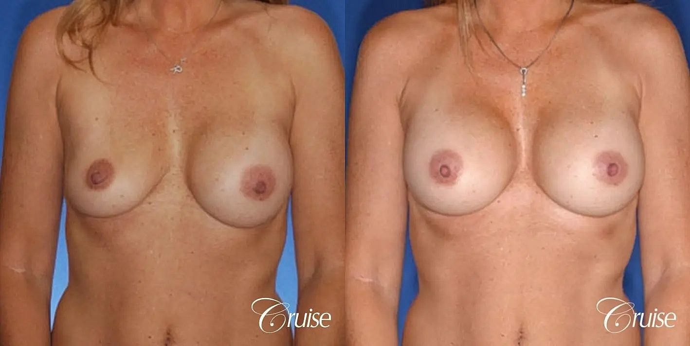 Breast Revision Before & After