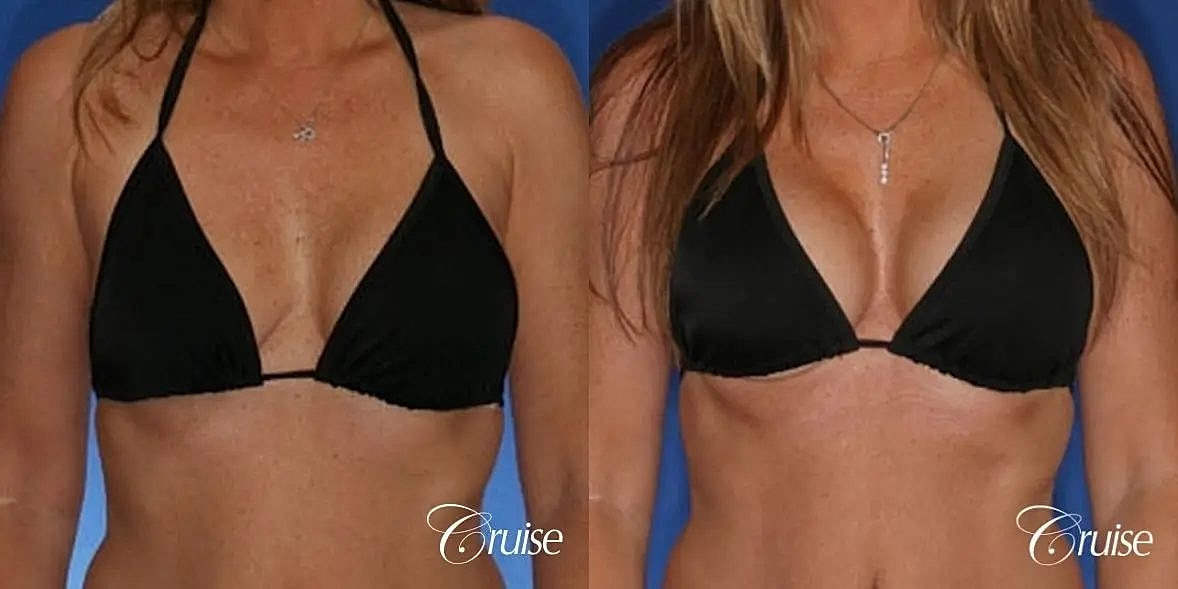 Breast Revision Before & After