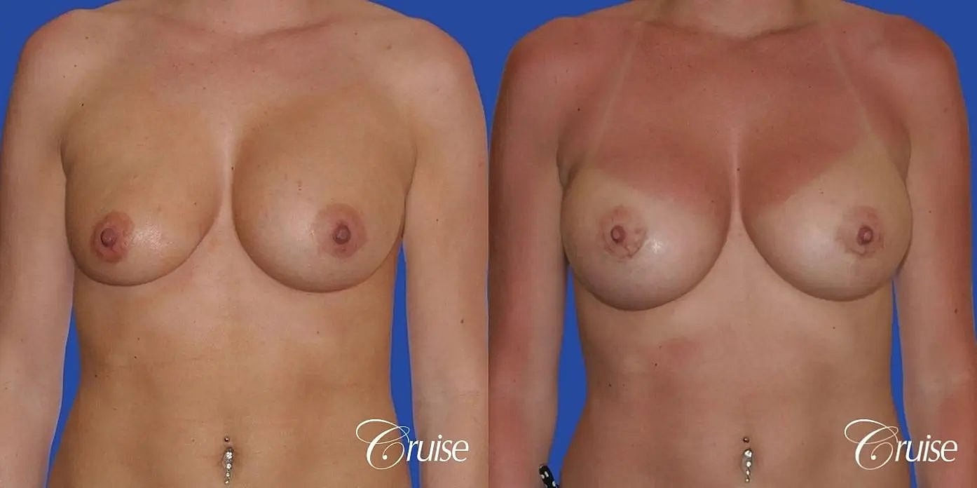 Breast Revision Before & After