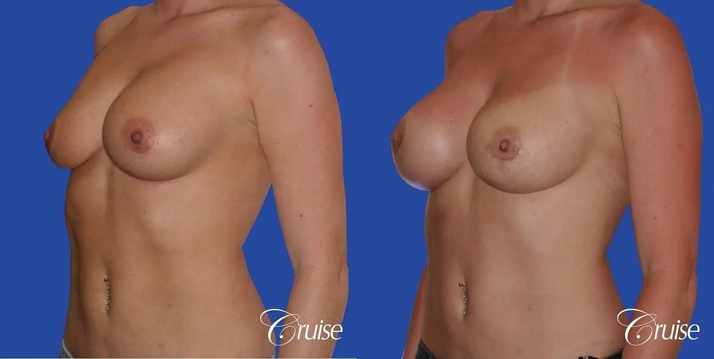 Breast Revision Before & After