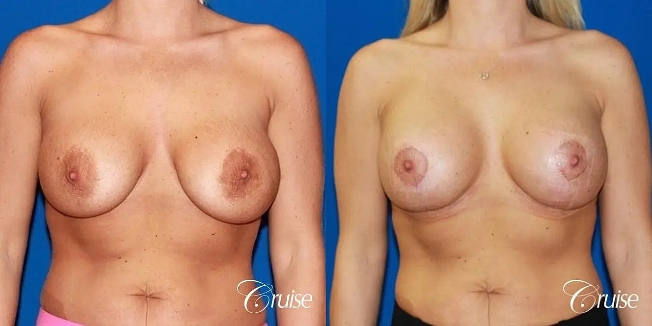 Breast Revision Before & After