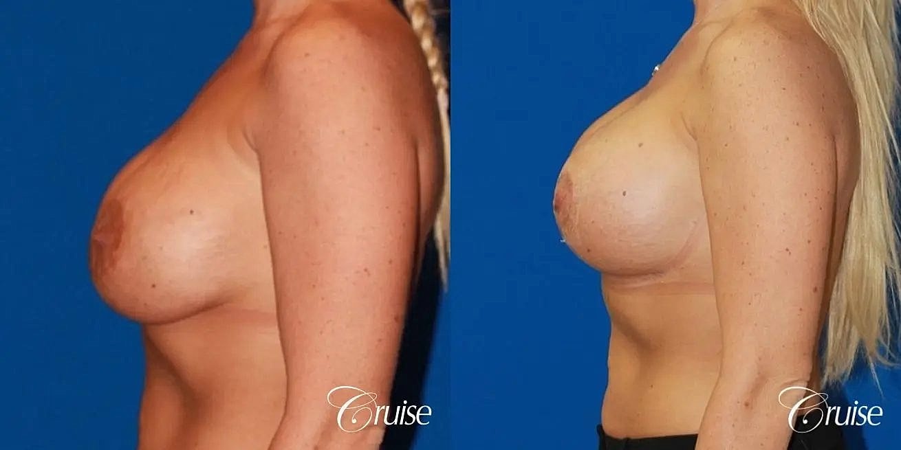 Breast Revision Before & After