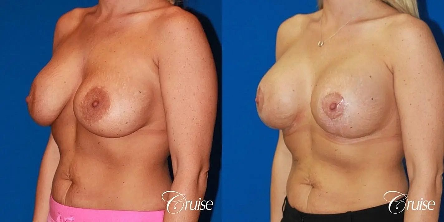 Breast Revision Before & After