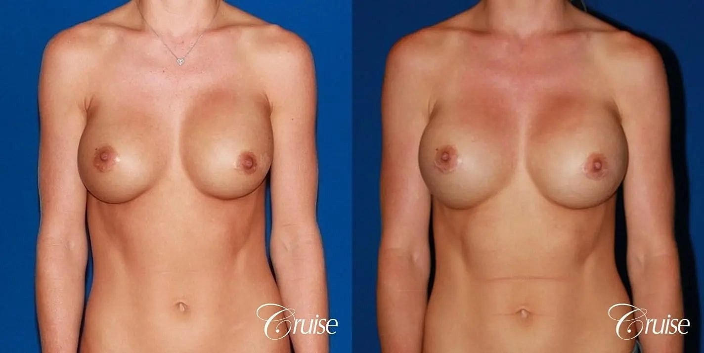 Breast Revision Before & After