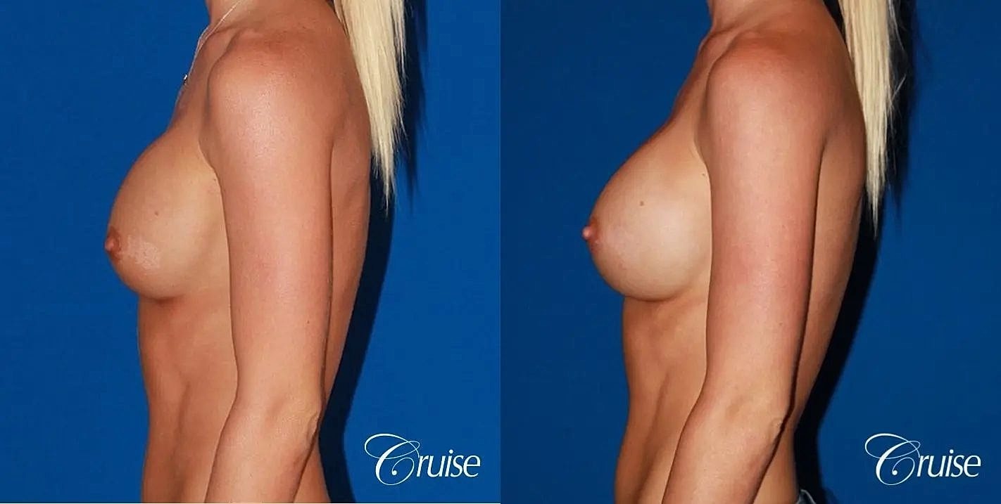 Breast Revision Before & After