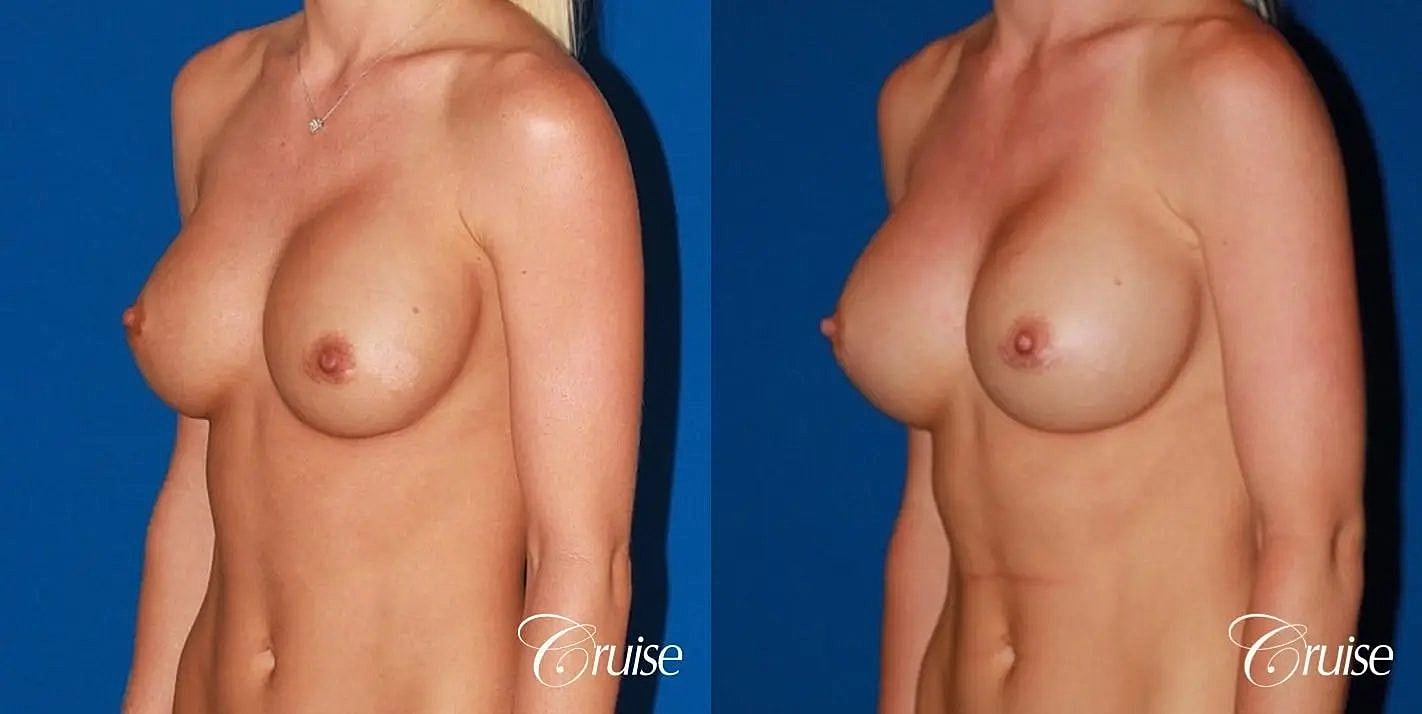 Breast Revision Before & After