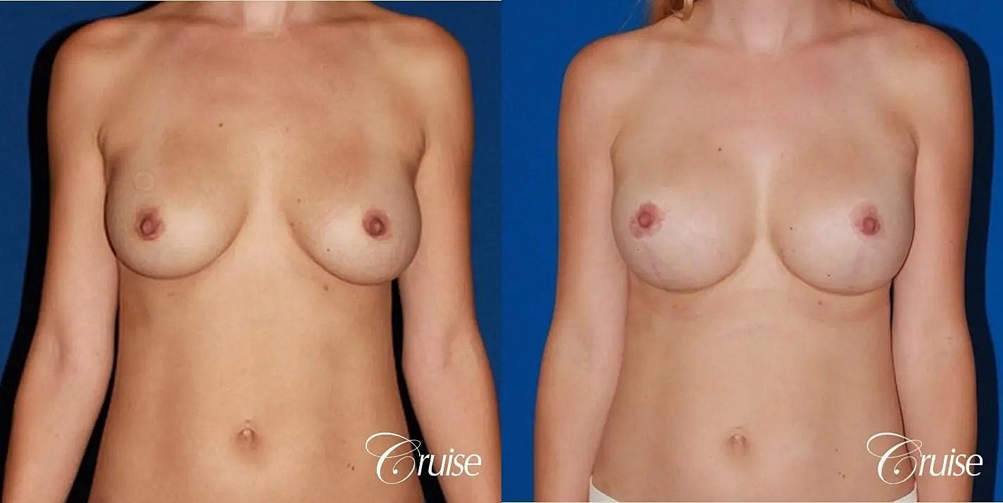 Breast Revision Before & After