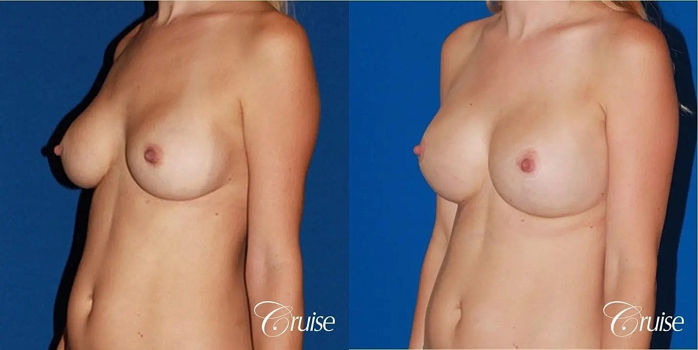 Breast Revision Before & After