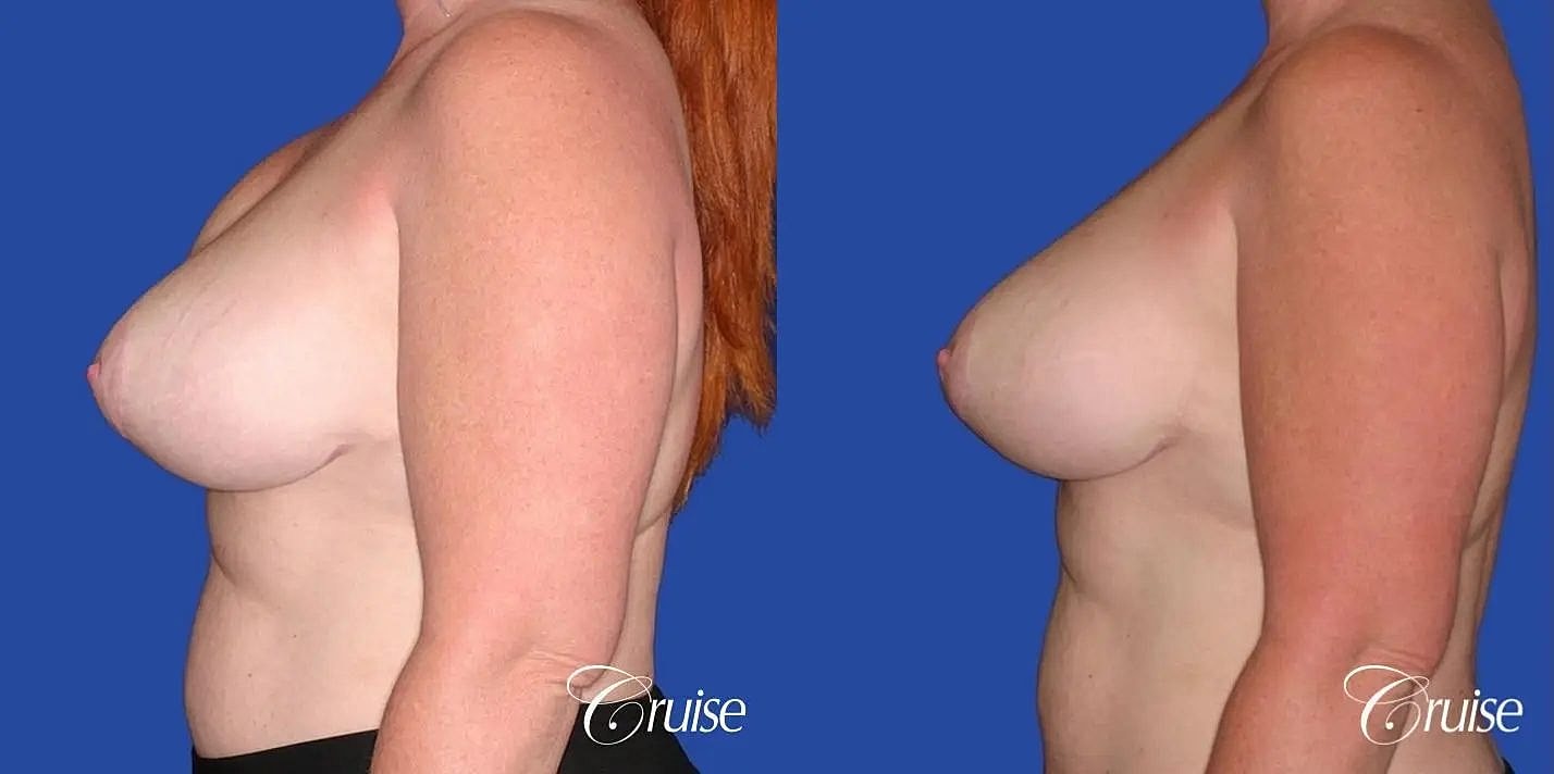 Breast Revision Before & After