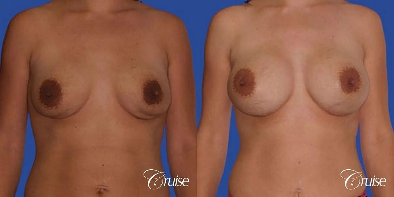 Breast Revision Before & After