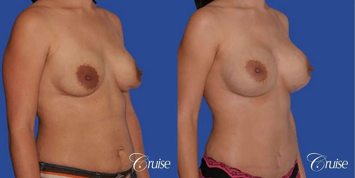 Breast Revision Before & After