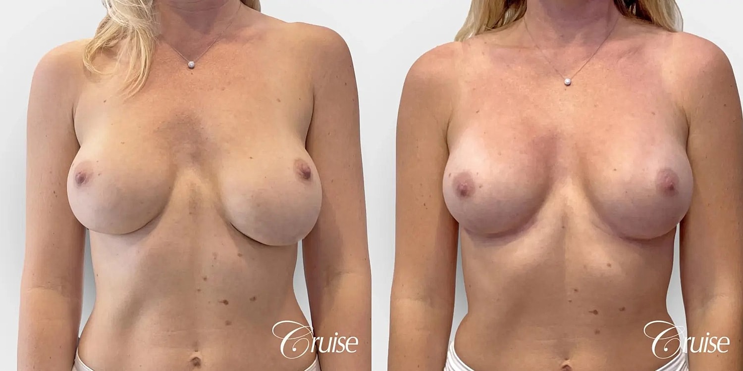 Breast Revision Before & After