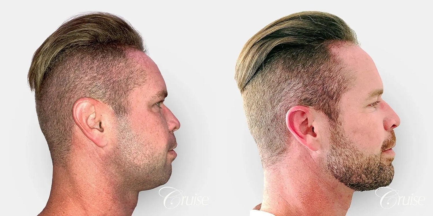 Chin Augmentation Before & After