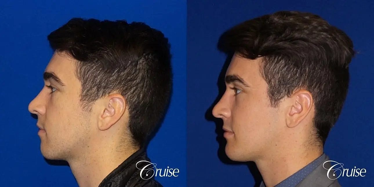 Chin Augmentation Before & After