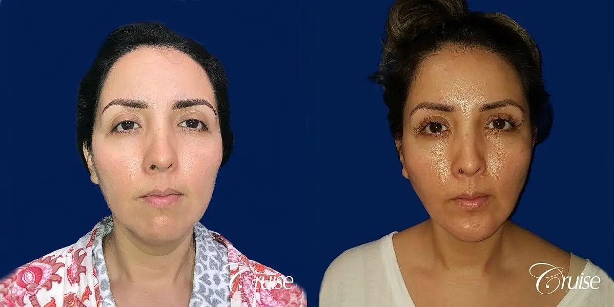 Chin Augmentation Before & After