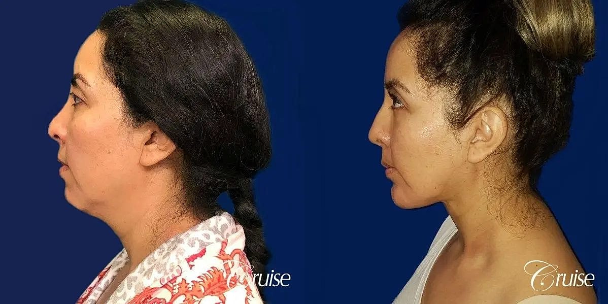Chin Augmentation Before & After