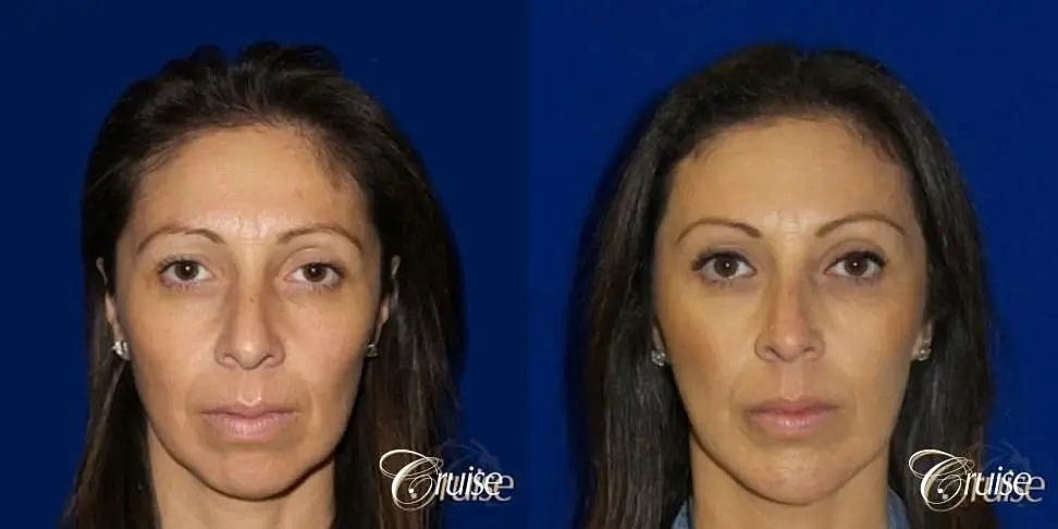 Chin Augmentation Before & After