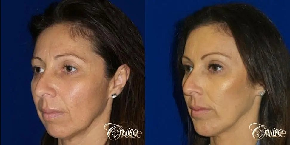 Chin Augmentation Before & After