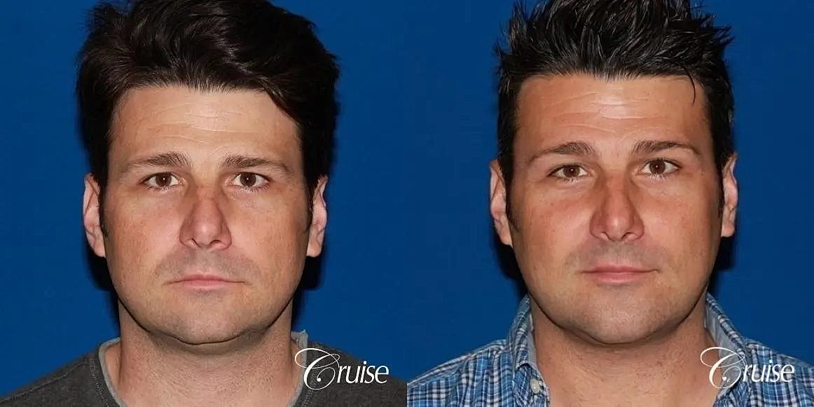 Chin Augmentation Before & After