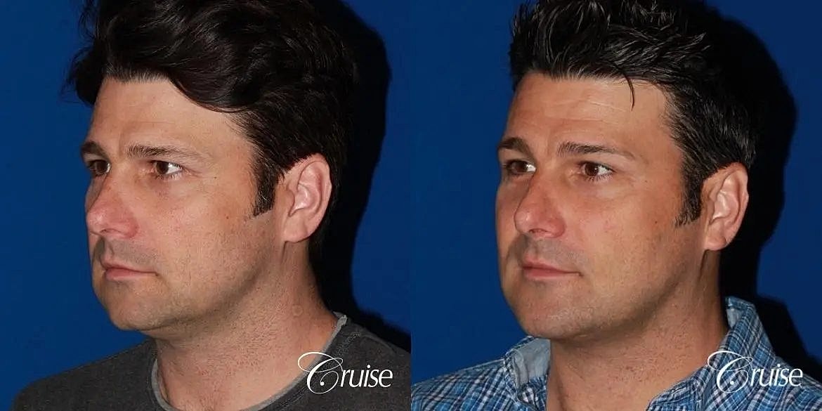 Chin Augmentation Before & After