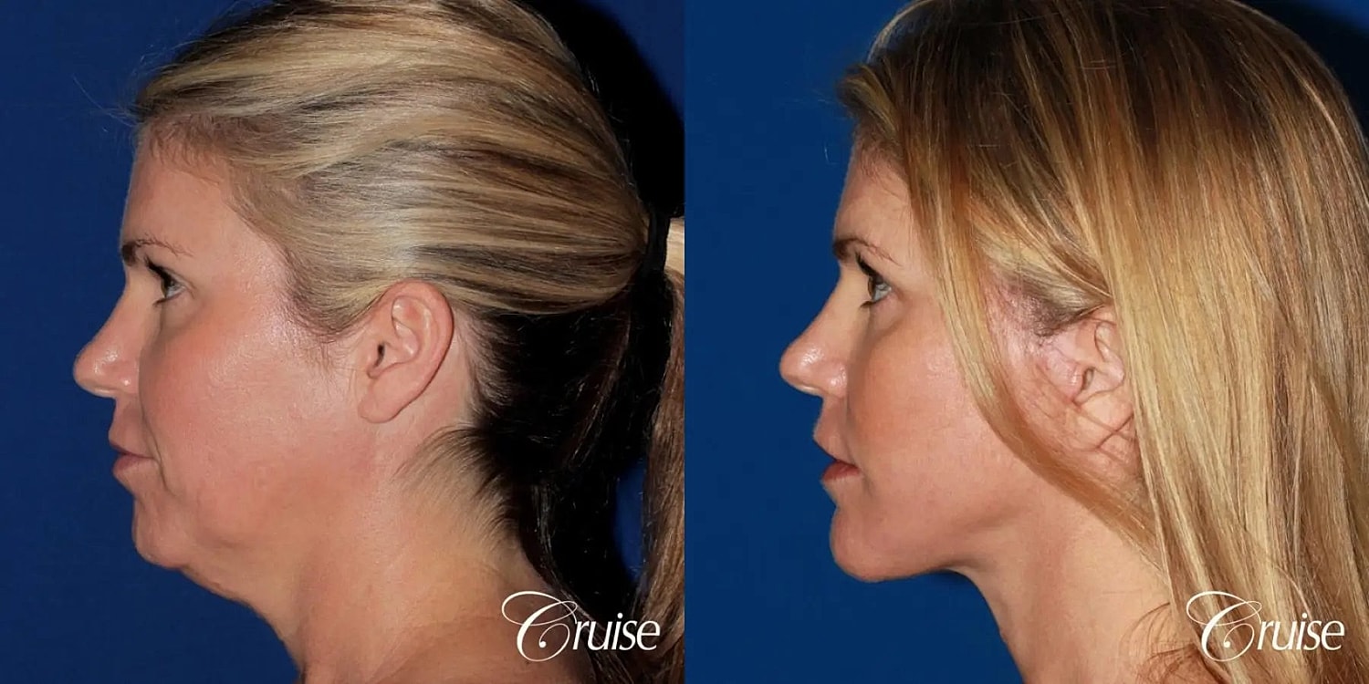 Chin Augmentation Before & After